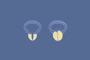 Prostate surgery can now be done in ADK Hospital