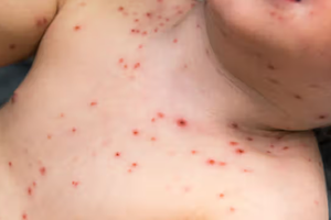 HPA issues alert on spread of chickenpox in Gulhi