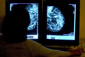 AI could halve time reading breast cancer scans