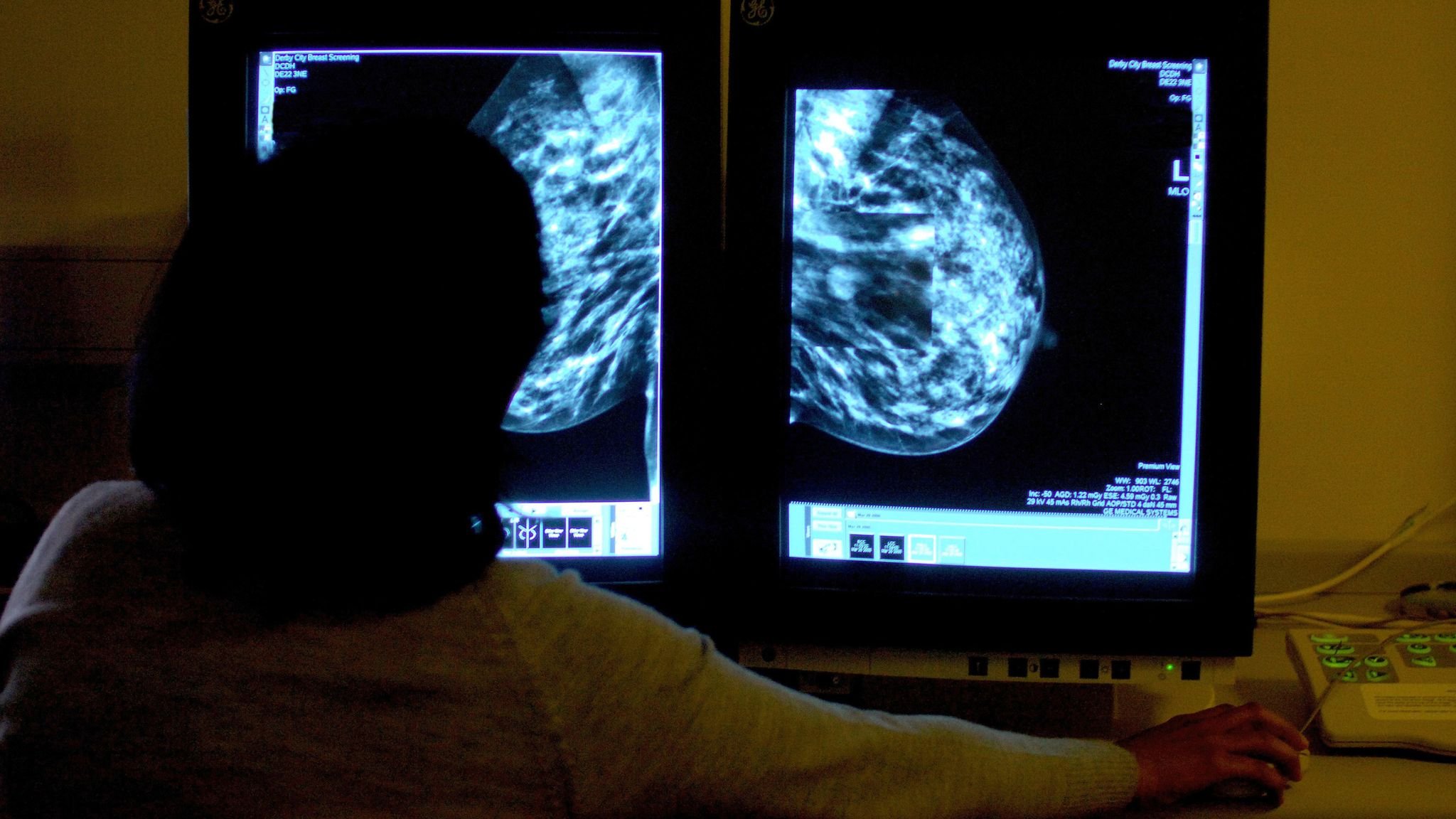 AI could halve time reading breast cancer scans